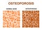 Normal bone and bone with osteoporosis