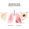 Normal bronchus and bronchiectasis. obstructive lung disease