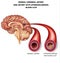 Normal cerebral artery and artery with blood clot