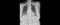 Normal chest x ray.Xray for diagnosis of pneumonia, tuberculosis TB and silicosis.