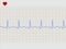 Normal electronic cardiogram. EPS 8