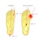 Normal foot and valgus deviation of the first toe with indicating of the deflection angles
