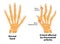 Normal hand and Rheumatoid Arthritis