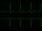 Normal Heart Rhythm