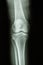 Normal human\'s knee joint