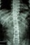 Normal humans thoracic-lumbar spine