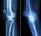 Normal knee left image and osteoarthritis knee right image lateral view