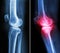 Normal knee and osteoarthritis knee