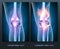 Normal knee and unhealthy knee joint