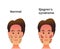 Normal lacrimal and salivary gland versus sjogren`s syndrome