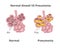 Normal lung alveoli versus pneumonia