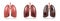 Normal lung and lung cancer illustration