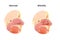 Normal nasal cavity versus rhinitis anatomy illustration