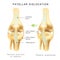 Normal position of kneecap and patella displaced