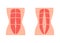 Normal tone muscle abdomen and diastasis recti, weak and divergence abdomen muscle. Rectus abdominal diastasis. Vector