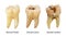 Normal tooth , Dental caries and Dental cavity with calculus . Comparison between difference of teeth decay stages . White