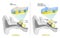 Normal vestibular system and Vertigo when Small calcified otoliths migrate from Saccule and Utricle into the semicircular canals