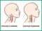 Normal vs. Reversal of Cervical Lordosis