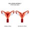 Normal womb and Bicornuate uterus