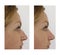 Nose hump correction before after procedures