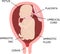 A nuchal cord. the umbilical cord is wrapped around the fetus s neck