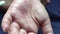 Nurse cleaning blisters shingles on patient hand