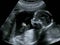 Obstetric Ultrasonography Ultrasound Echography of a first month