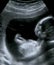 Obstetric Ultrasonography Ultrasound Echography of a first months fetus