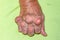 Old age and illnesses of pharmaceutical medicament severe gout in men suffering from joint pain, bone pain, gout ,arthritis ,arm,