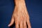 Old hand. Arm with large bulging veins.