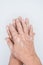 Old hands with vitiligo skin disorder on white background