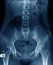 Old man x-ray, lumbar x-ray image with pelvic bone