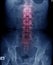 Old man x-ray, lumbar x-ray image with pelvic bone