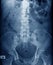 Old man x-ray, lumbar x-ray image with pelvic bone