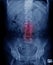 Old man x-ray, lumbar x-ray image with pelvic bone