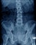 Old man x-ray, lumbar x-ray image with pelvic bone