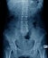 Old man x-ray, lumbar x-ray image with pelvic bone