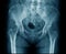 Old man x-ray, lumbar x-ray image with pelvic bone