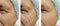 Old man with wrinkles on face results difference cosmetology before and after procedures arrow