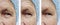 Old man with wrinkles removal on face results difference cosmetology before and after procedures arrow