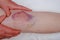Old woman\'s leg, scar, bruise, pain