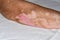 An old woman& x27;s right elbow damaged by vitiligo and burn scars.