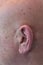 Older man close view of ear with no hair, bald, alopecia, chemotherapy, cancer