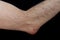 Olecranon bursitis, also known as studentâ€™s elbow