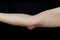 Olecranon bursitis, also known as studentâ€™s elbow