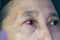 One annoyed red blood eye of female affected by conjunctivitis or after flu, cold or allergy. Conjunctivitis condition. One female