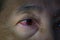 One annoyed red blood eye of female affected by conjunctivitis or after flu, cold or allergy. Conjunctivitis condition. One female