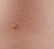 One mole spot on human skin