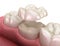 Onlay ceramic crown fixation over molar tooth. Medically accurate 3D illustration of human teeth treatment