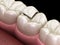 Onlay ceramic crown fixation over tooth. Medically accurate 3D illustration of human teeth